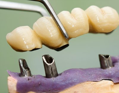 Na czym polega leczenie&nbsp;protetyczne?